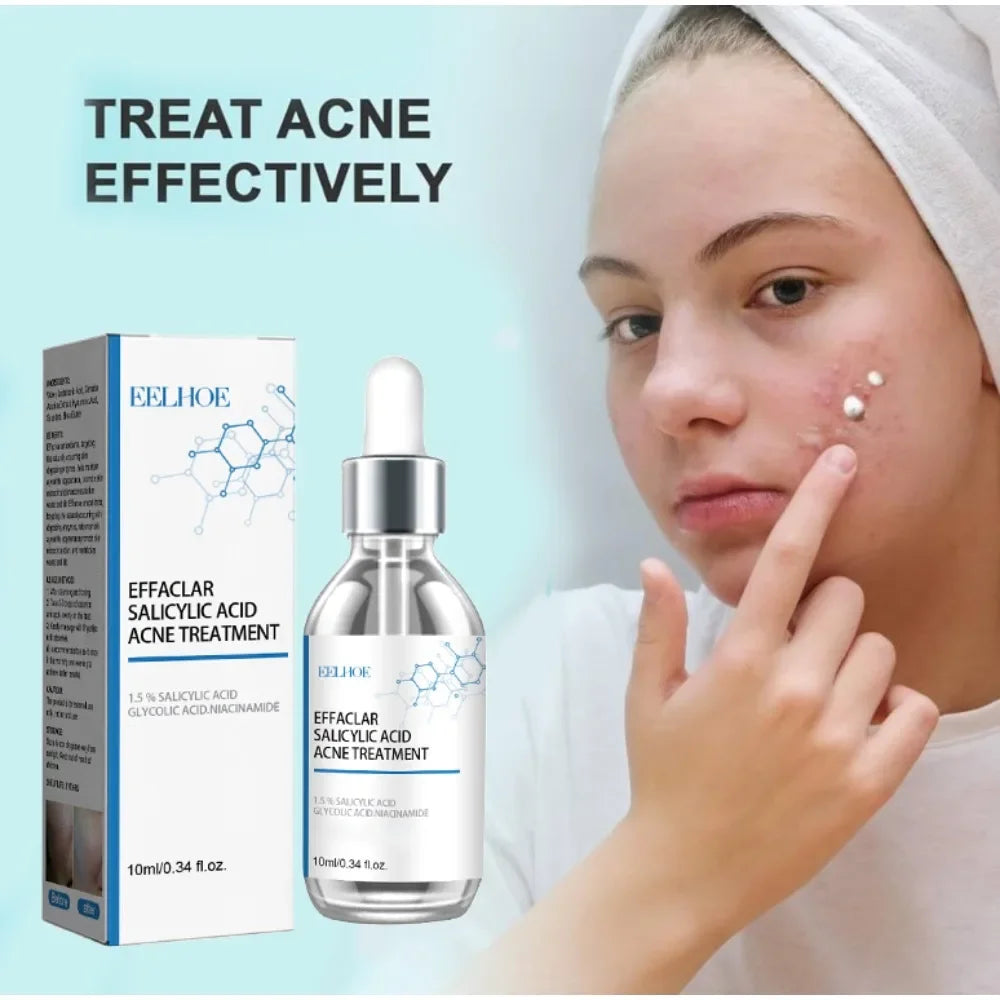 Face Serum Acne Treatment